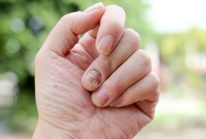 指甲黴菌感染原因