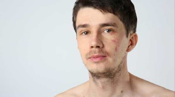 念珠菌感染原因