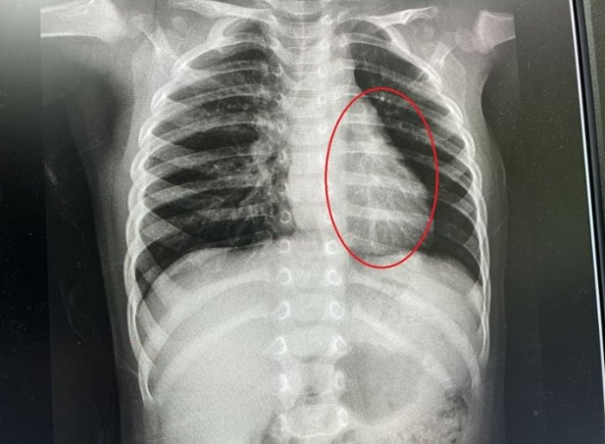 黴漿菌感染原因