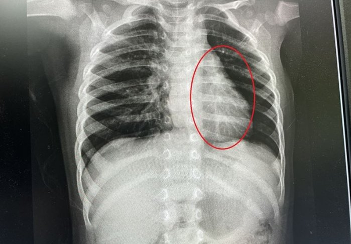 黴漿菌感染原因