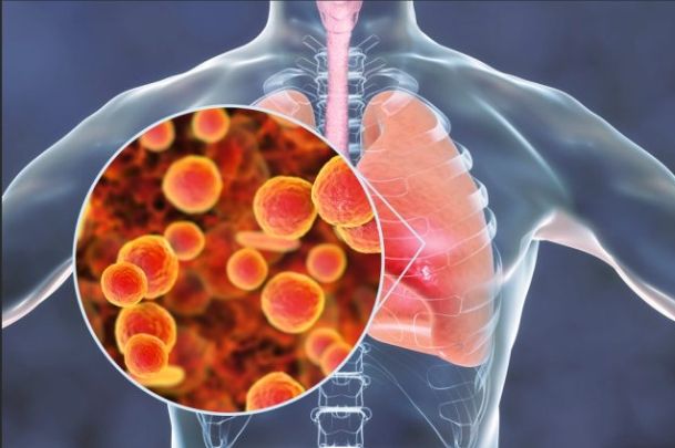 黴漿菌感染症狀