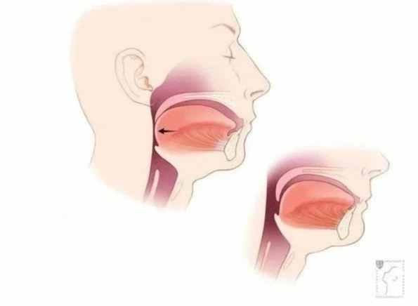 上呼吸道感染預防