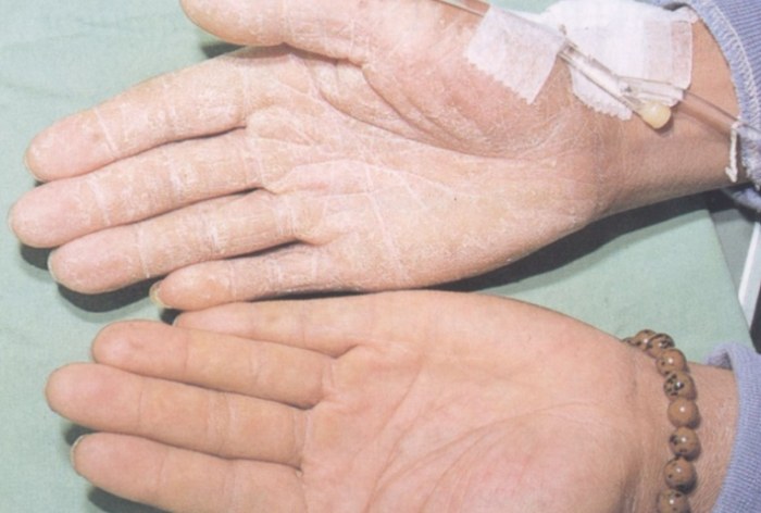 黴菌感染傳染嗎