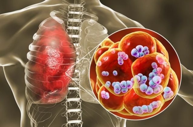 黴漿菌感染症狀