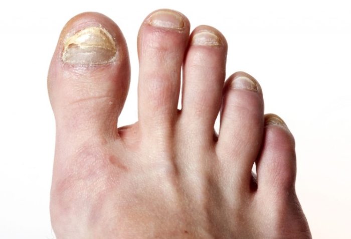 指甲黴菌感染如何治療