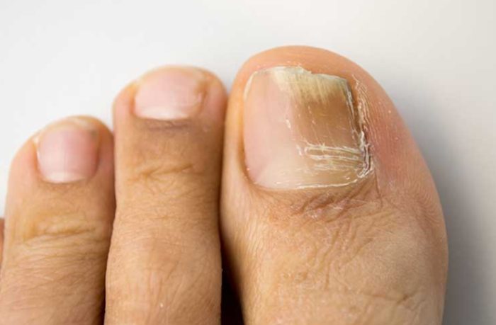 指甲黴菌感染怎麼辦