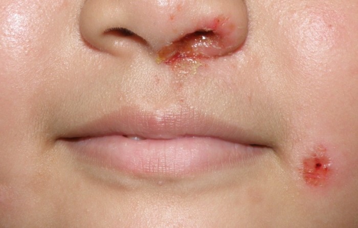 皮膚黴菌感染特徵