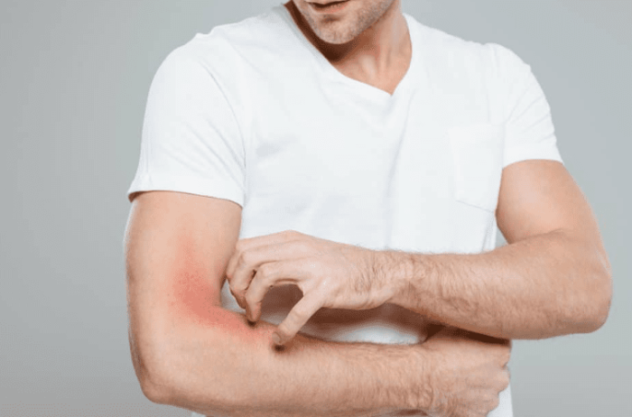 念珠菌感染藥膏