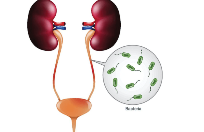 泌尿道感染護理措施