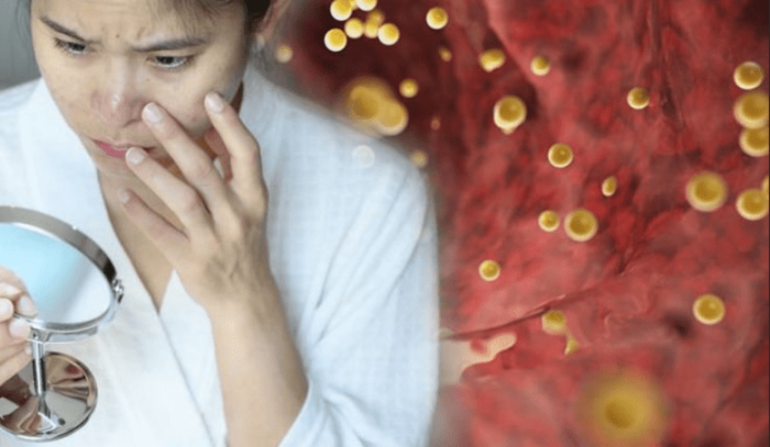 念珠菌感染原因