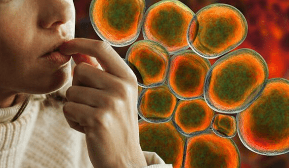 念珠菌感染護理措施