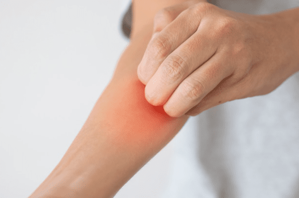 黴菌感染的治療方法