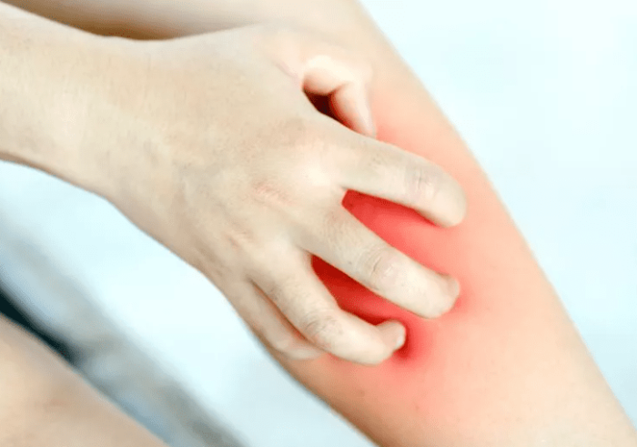 黴菌感染的預防與日常護理