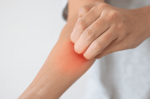 黴漿菌感染治療